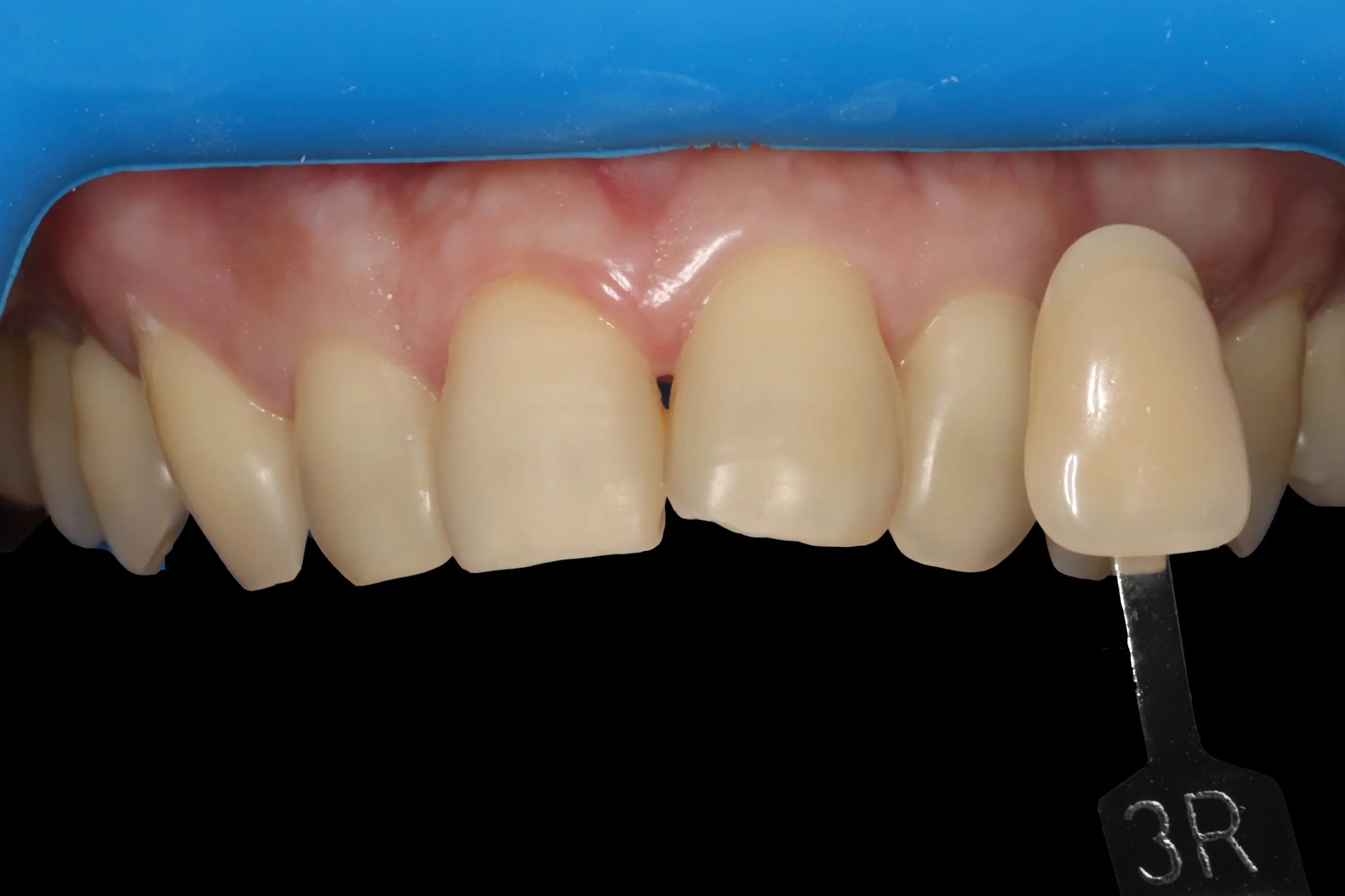 After tooth whitening After tooth whitening