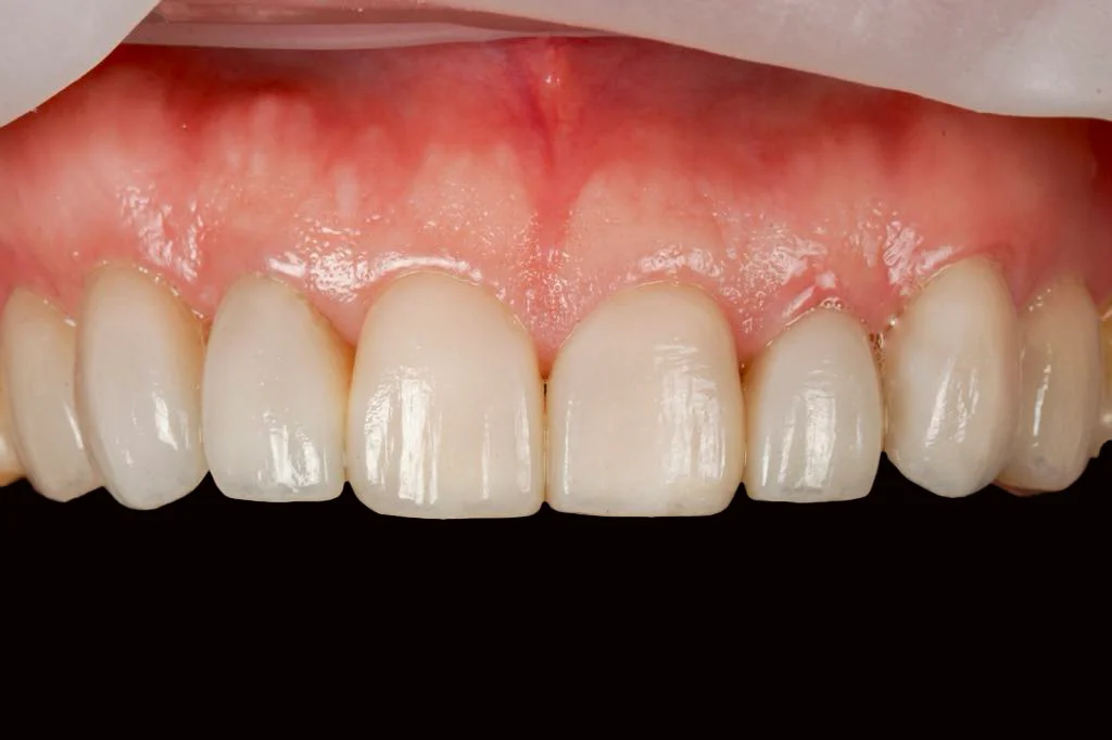 After veneer After veneer