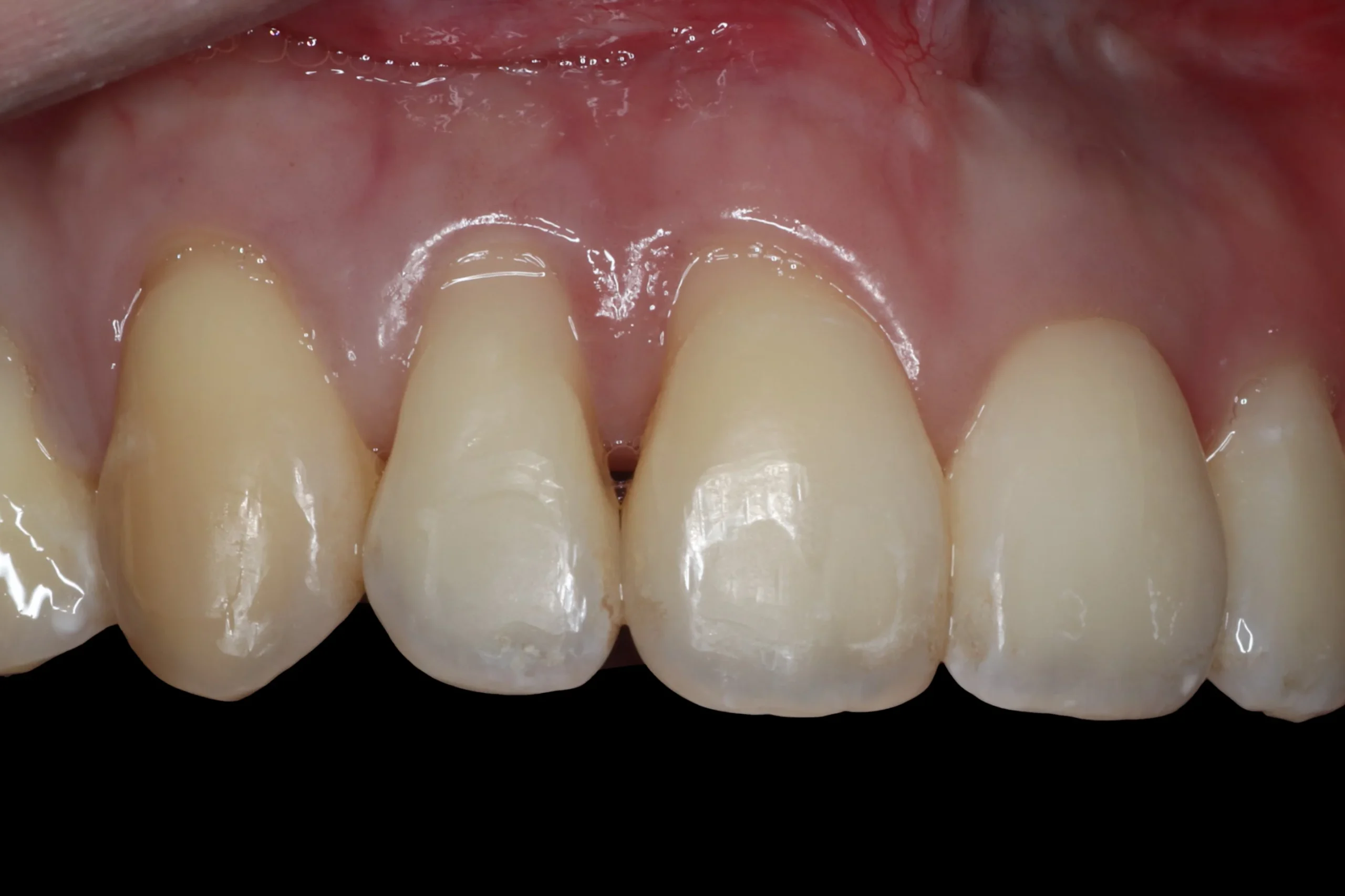 Before gum graft Before gum graft
